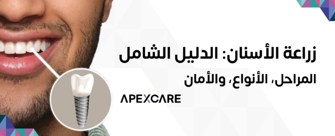 زراعة الأسنان – عيادات أبكس كير بالقصيم