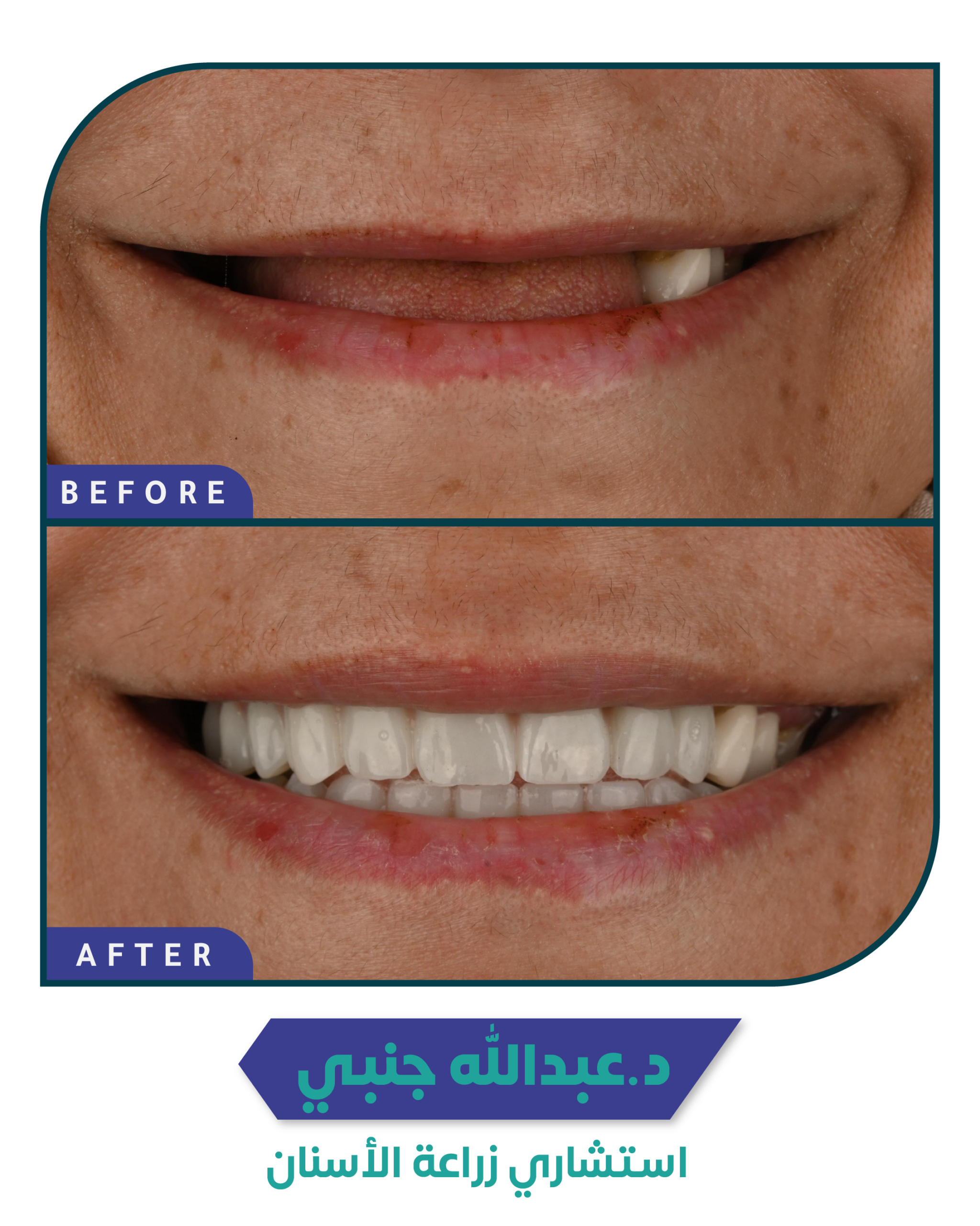 زراعة الأسنان 